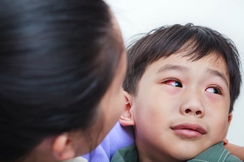 Chỉ nhìn vào mắt của người bệnh đau mắt đỏ sẽ không lây truyền bệnh