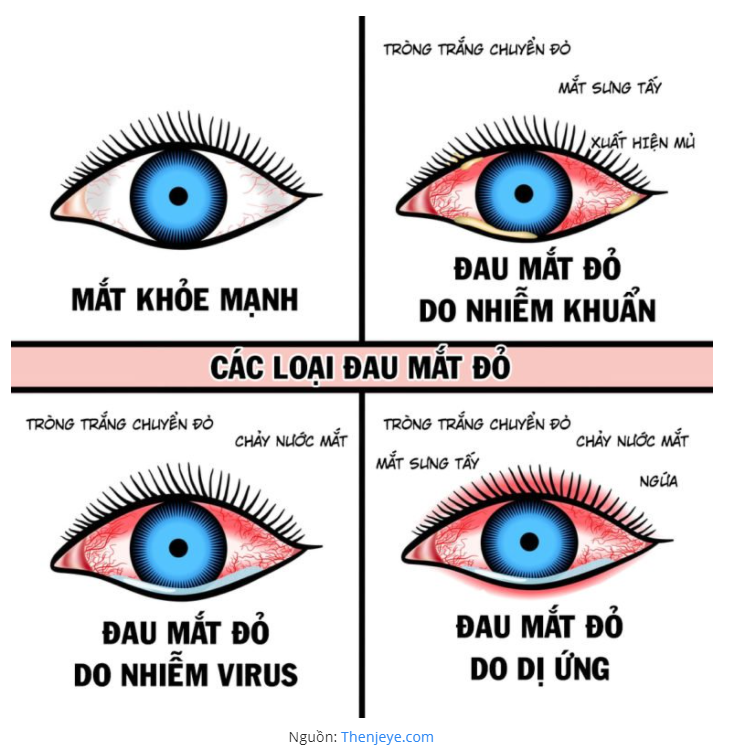 Đau mắt đỏ